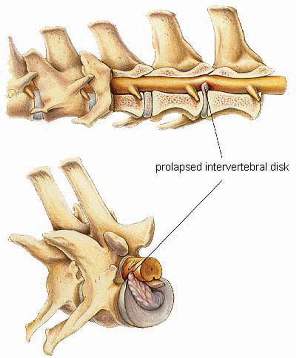 Ivdd Artwork Showing Prolapsed Intervertebral Disk