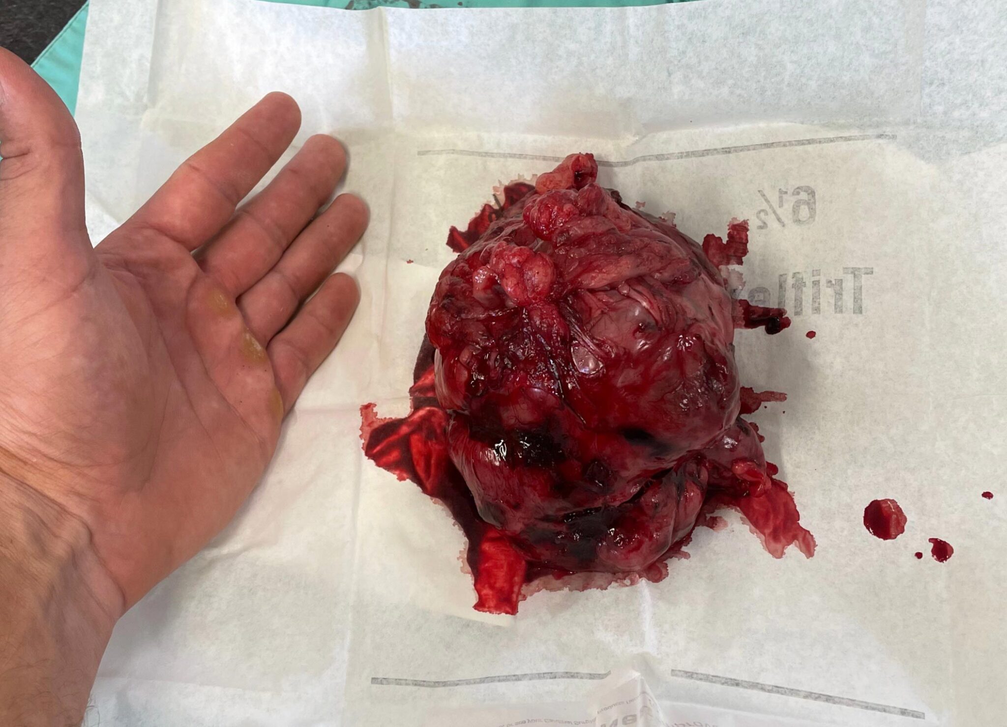 Abdominal Mass Removed