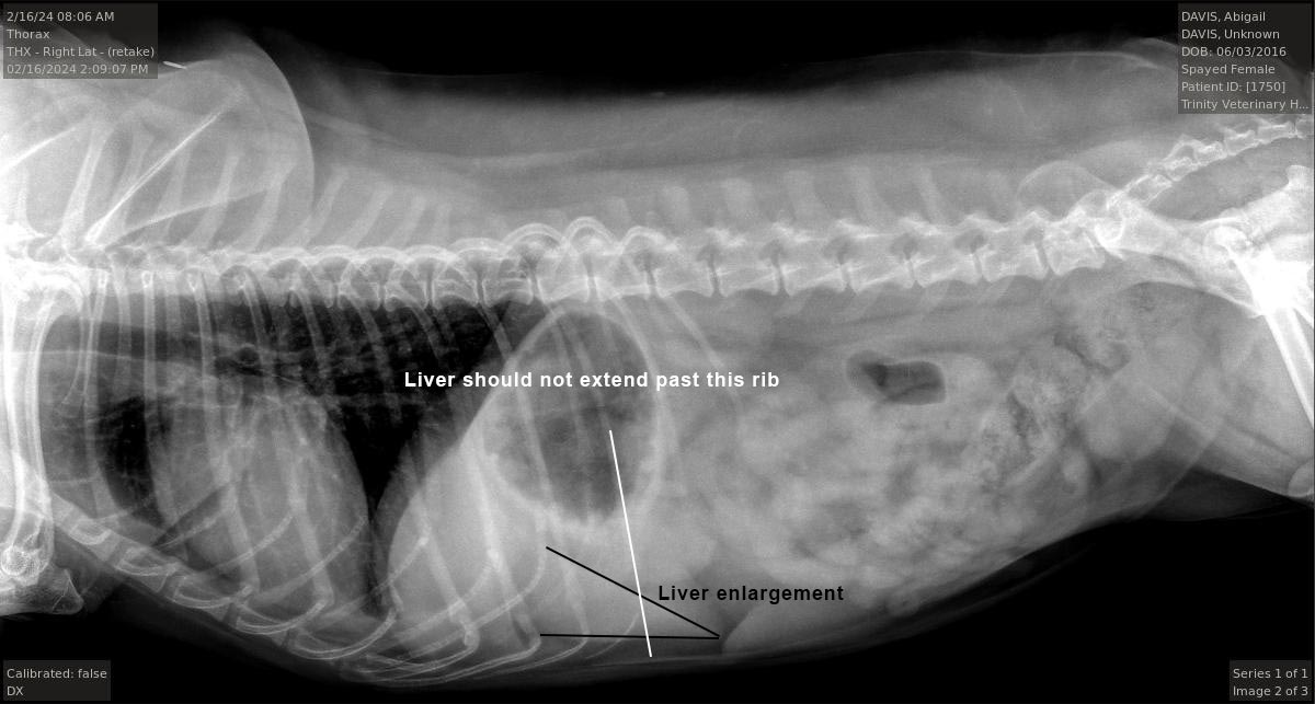 Abigail Enlarged Liver Defined Radiograph
