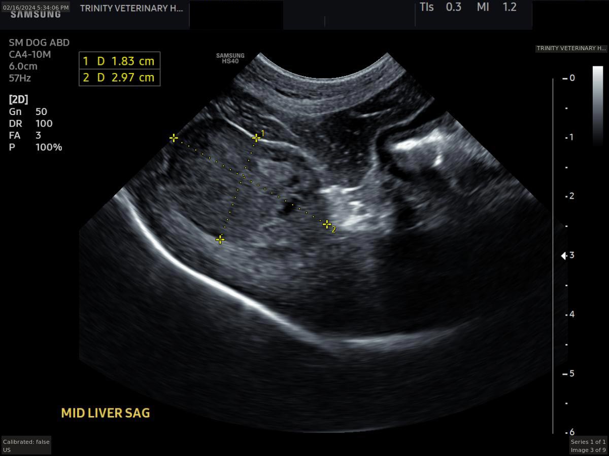 Abigail Liver Mass Measured