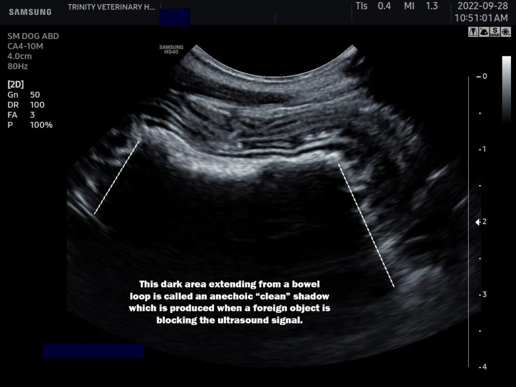 Clean Shadow Foreign Object In Intestines